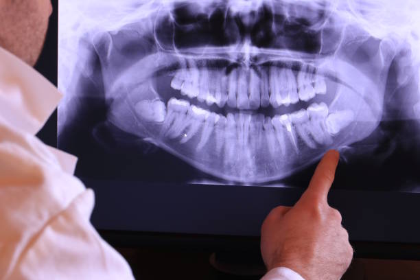 Best Emergency Wisdom Teeth Removal in Juneau, WI